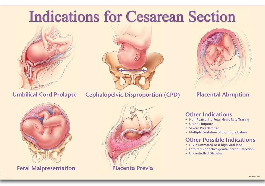 Indications/Reasons for Cesarean Sections