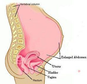 Pseudocyesis / False Pregnancy - Aries Ob/Gyn Clinic