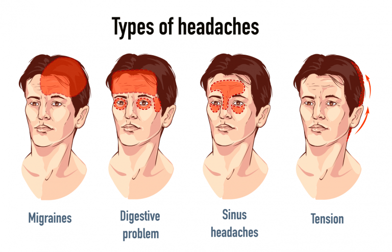 Types of headaches